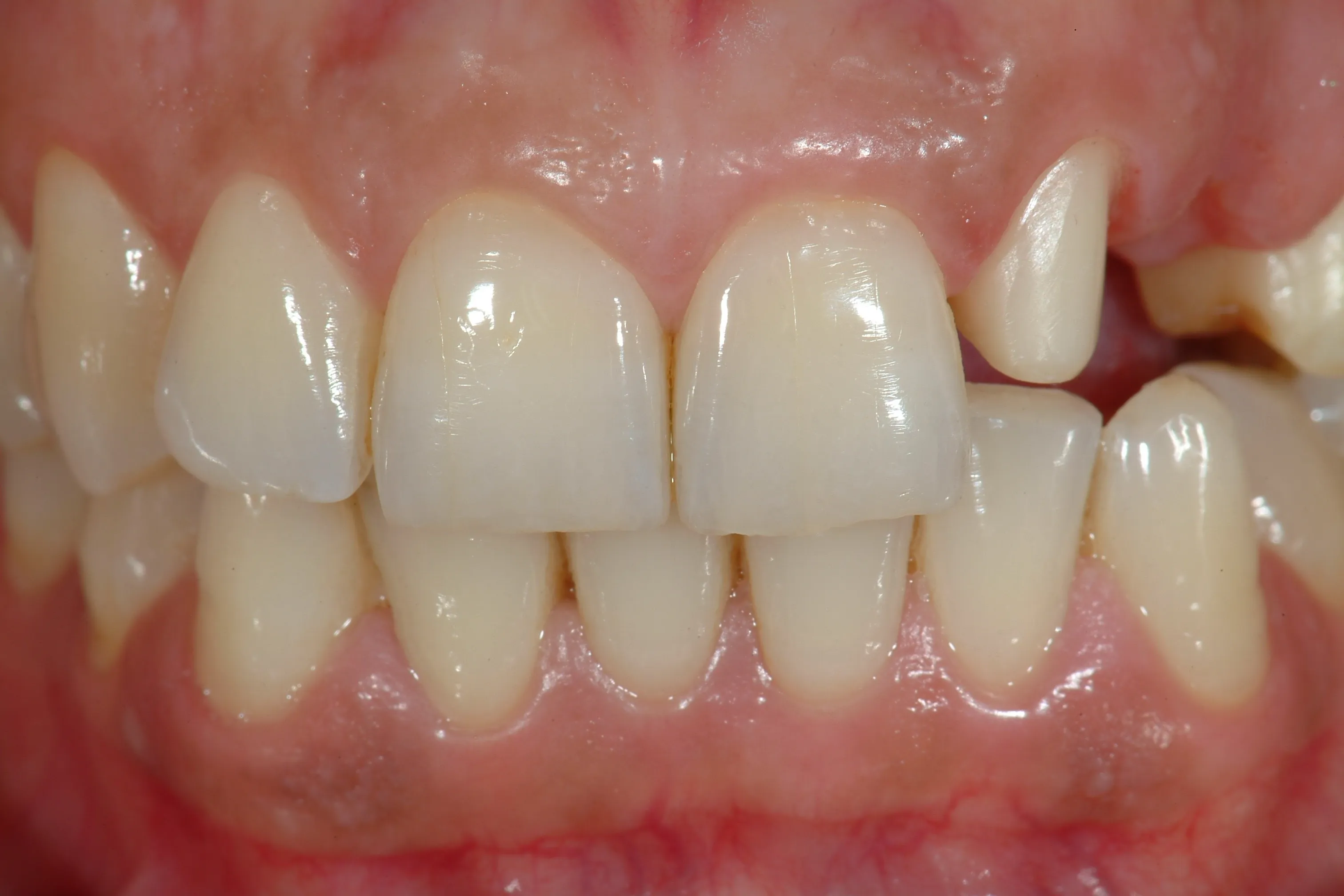 Prima del trattamento - Riabilitazione protesica